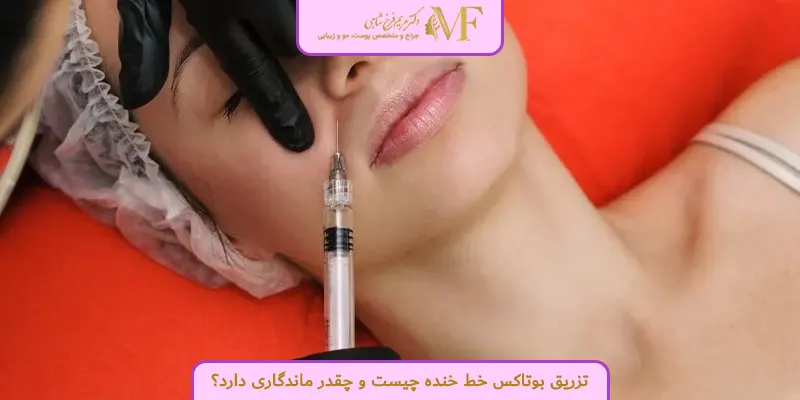 تزریق بوتاکس خط خنده چیست و چقدر ماندگاری دارد؟