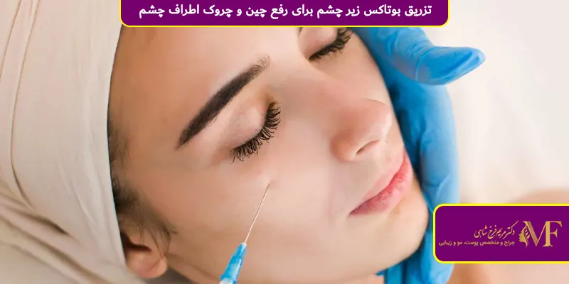 تزریق بوتاکس زیر چشم برای رفع چین و چروک اطراف چشم