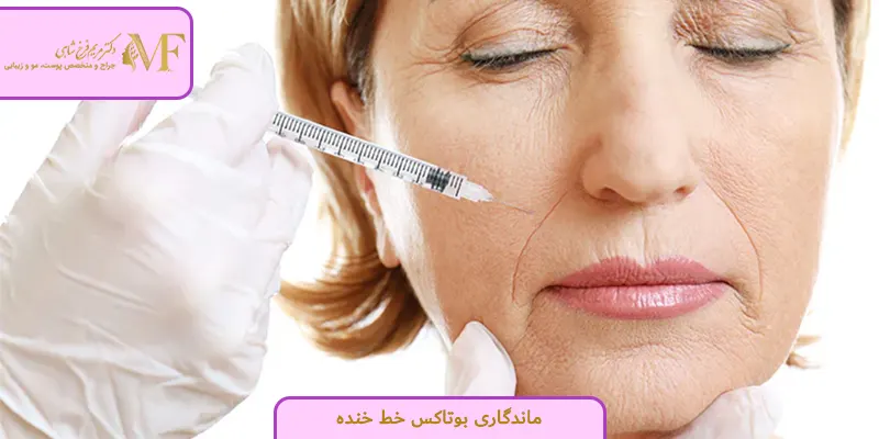 ماندگاری بوتاکس خط خنده