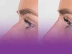 تزریق فیلر بینی